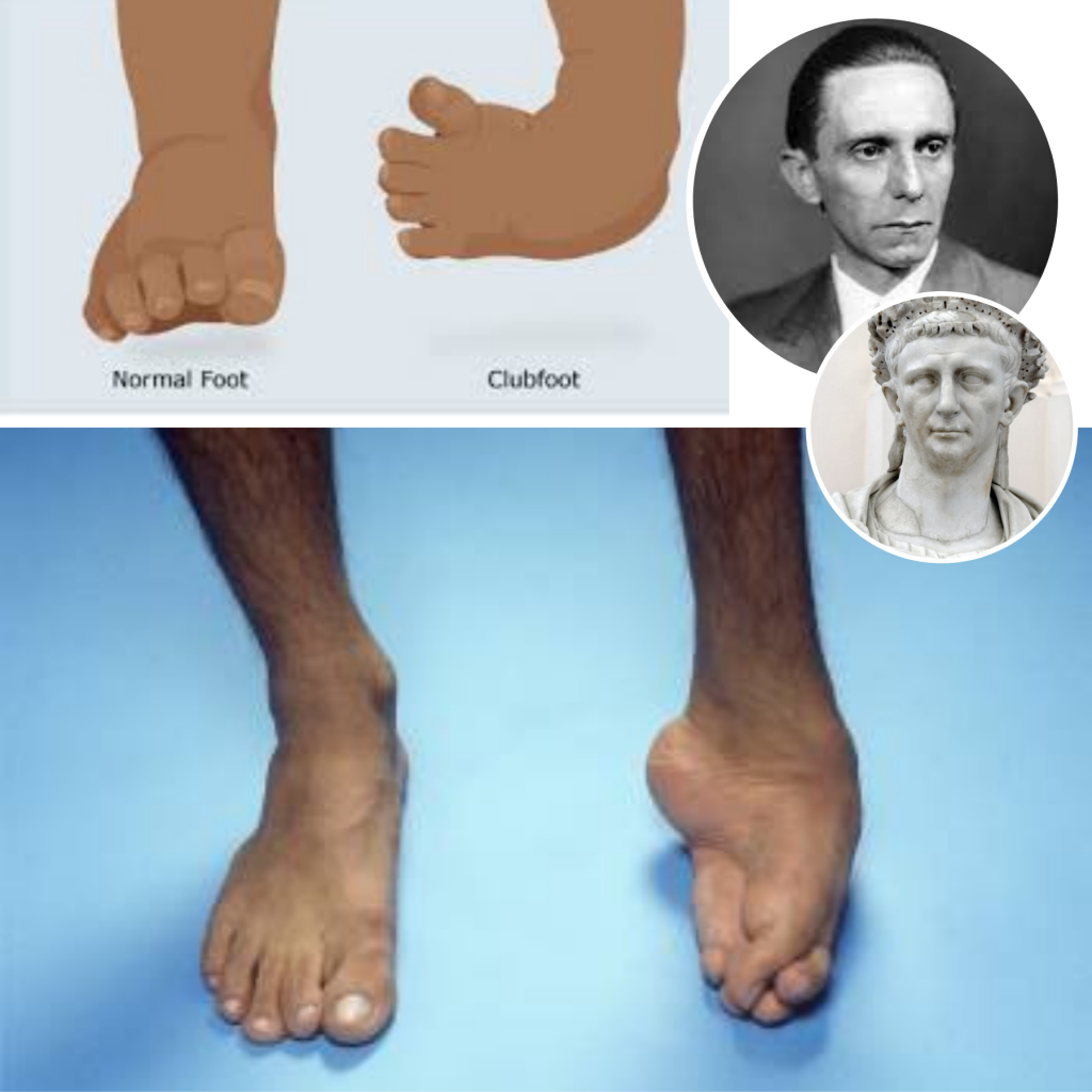 Noha kososvislá - vada, kterou měl George Gordon Byron, Joseph Goebbels nebo císař Claudius